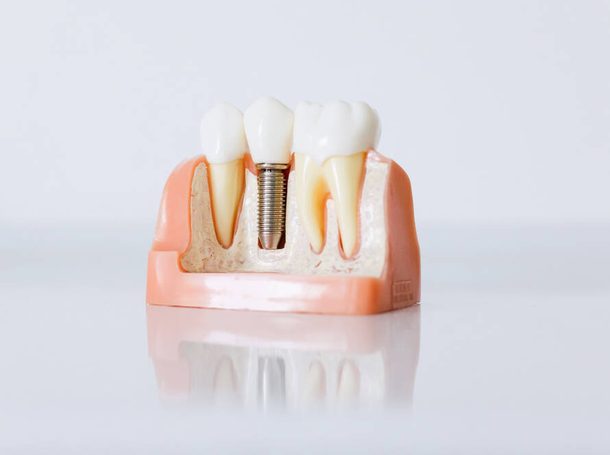Modello anatomico di impianto dentale con corona protesica