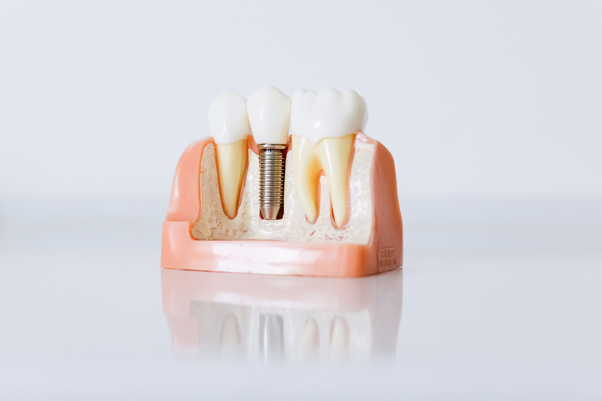 Implantologia dentale